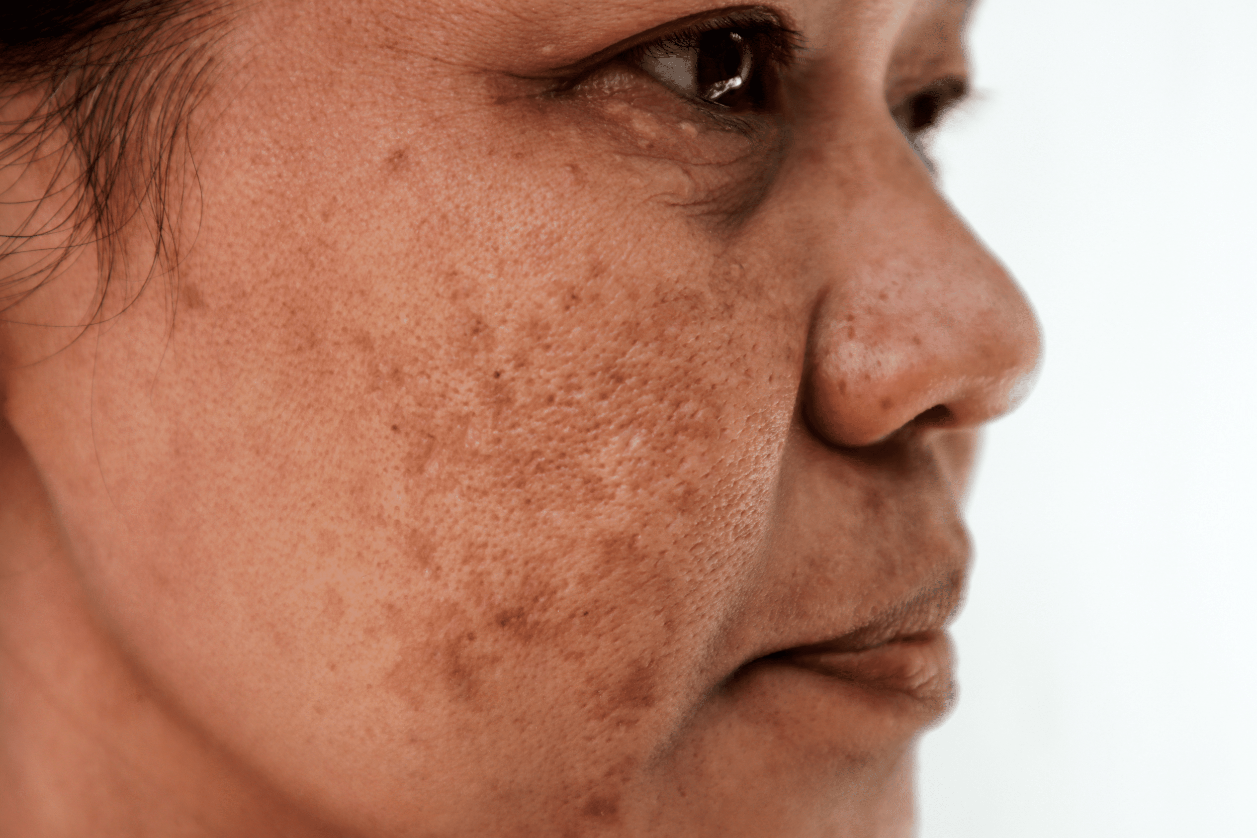 woman with melasma on cheek