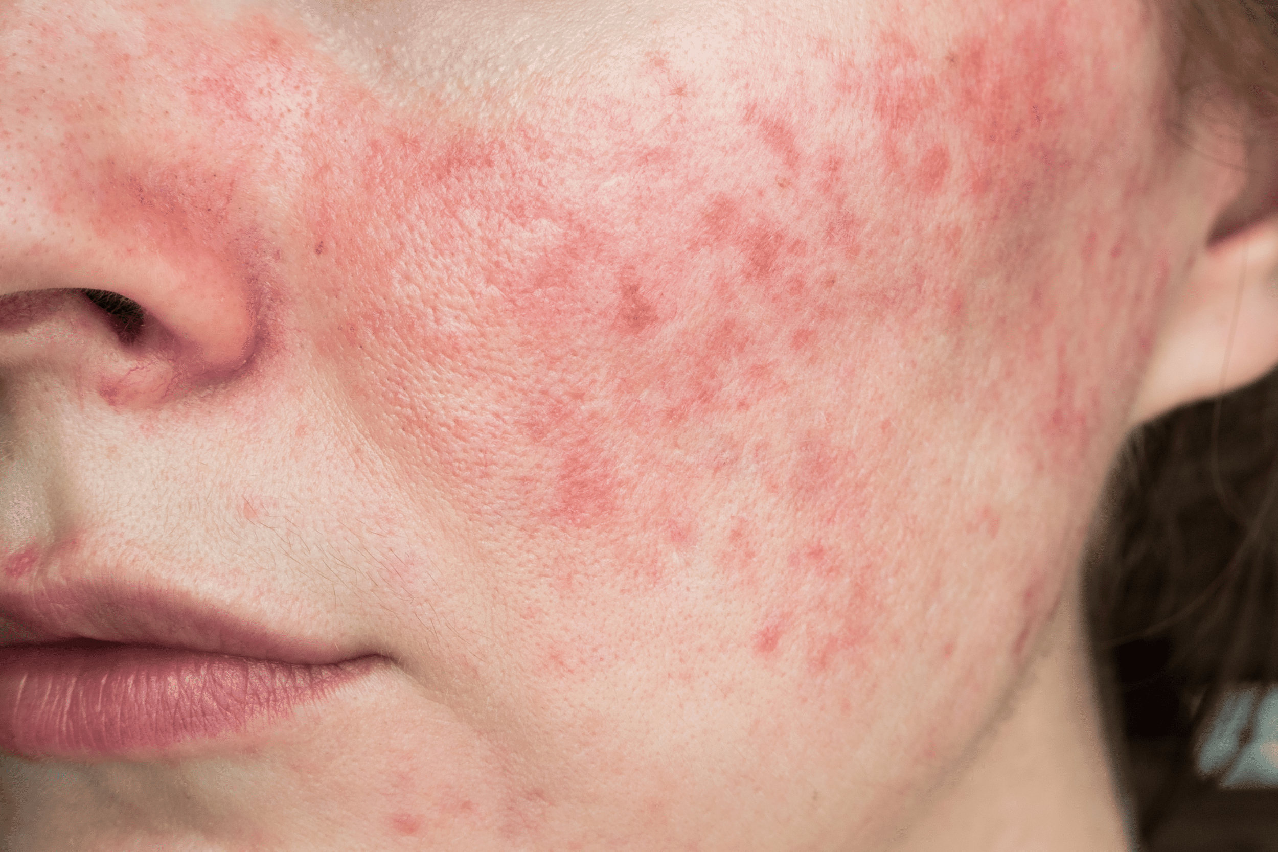 up close of cheek with red rosacea patches on cheek