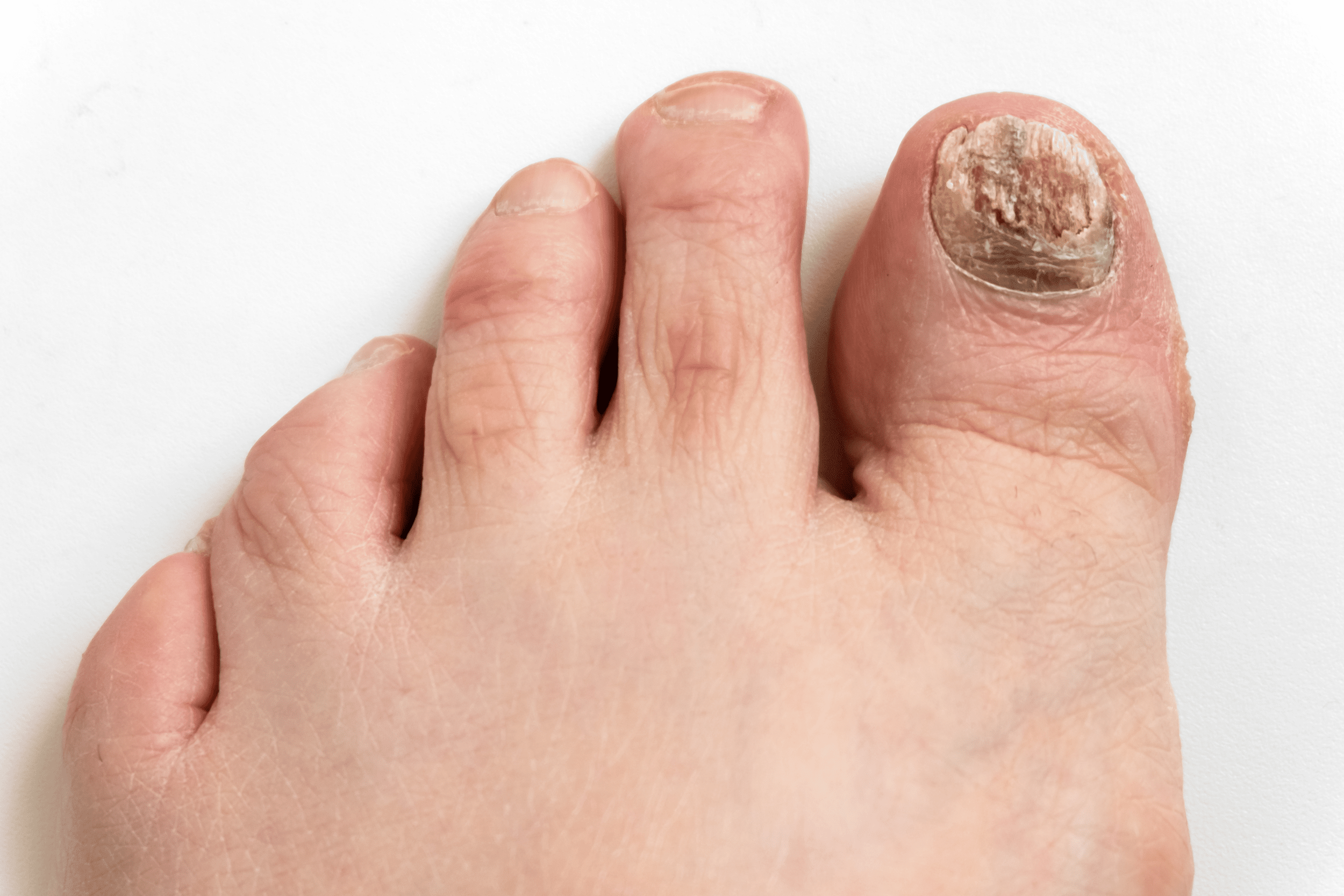 toenail fungus on patient's big toe