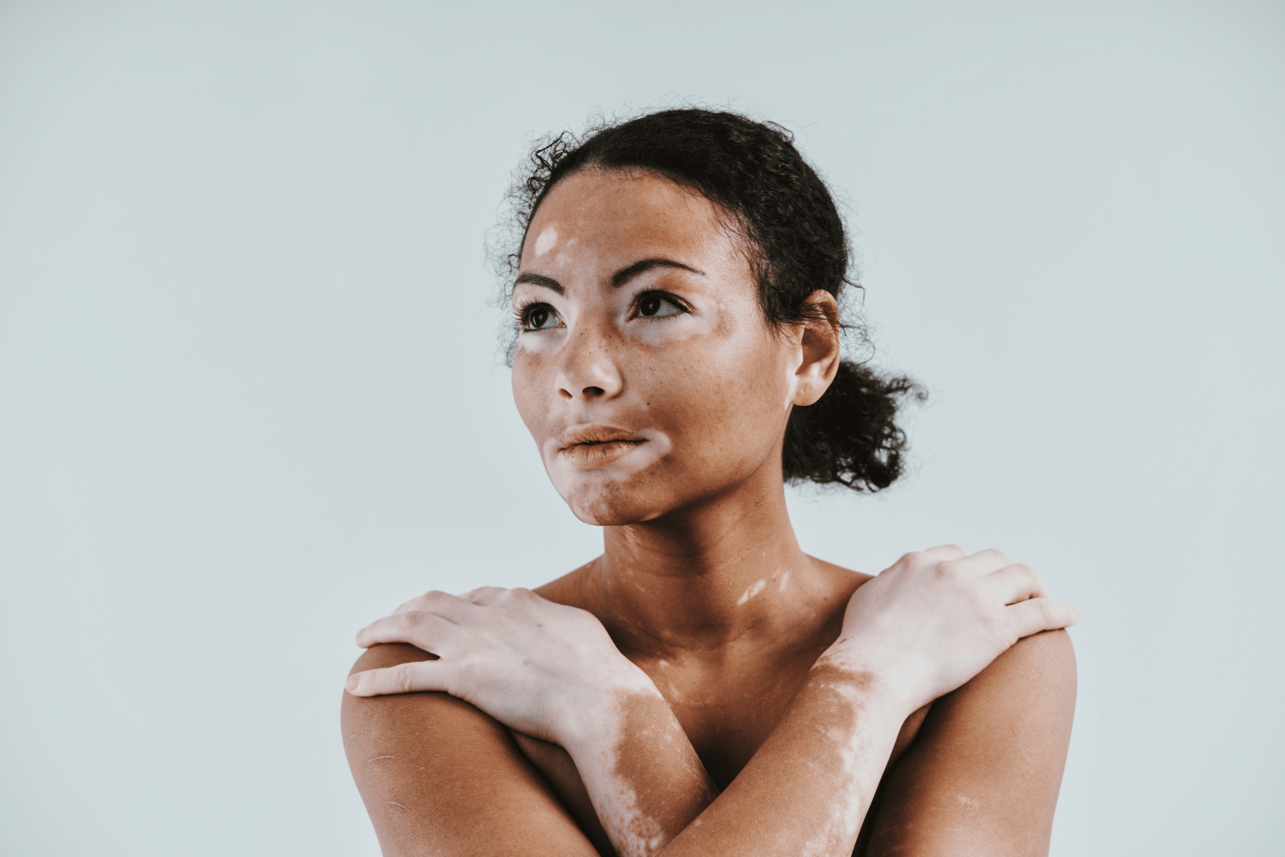 young woman with vitiligo
