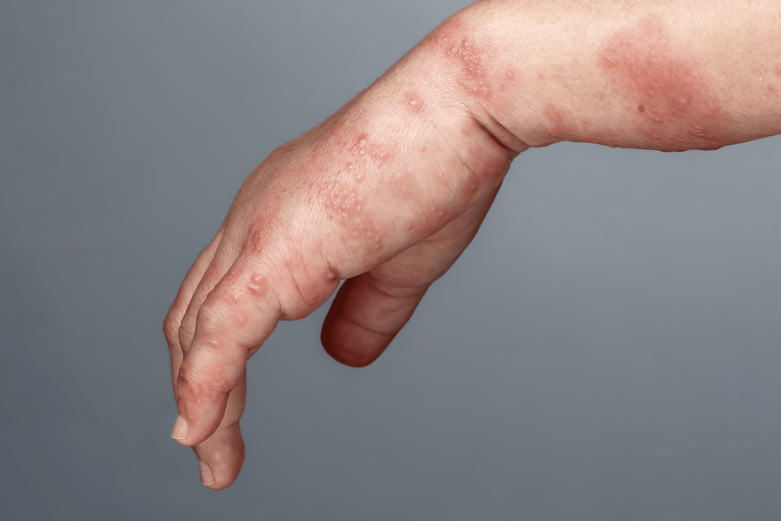 hand with red scabies patches